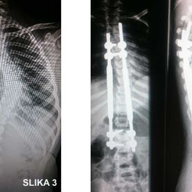 Prva operacija skolioze v Kirurškem sanatoriju MD medicina z novo metodo magnetnih palic - slika 3
