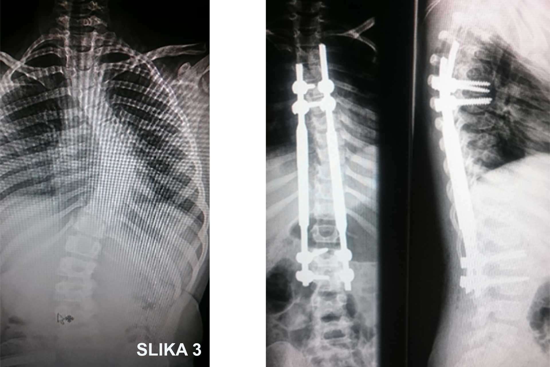 Prva operacija skolioze v Kirurškem sanatoriju MD medicina z novo metodo magnetnih palic - slika 3