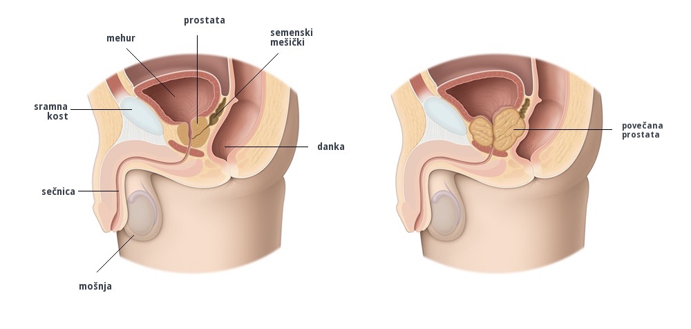 Benigno povečanje prostate