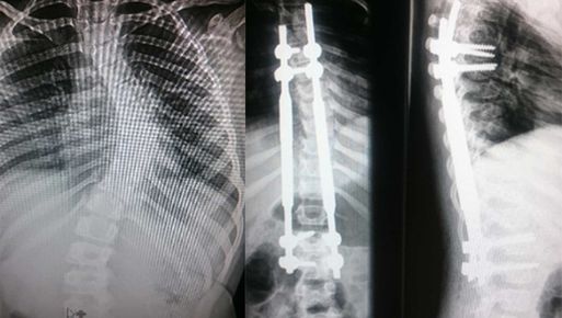 Prva operacija skolioze v Kirurškem sanatoriju MD medicina z novo metodo magnetnih palic
