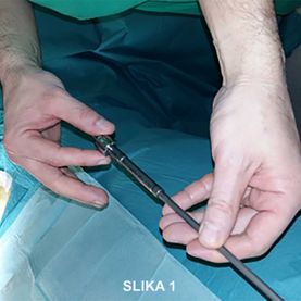 Prva operacija skolioze v Kirurškem sanatoriju MD medicina z novo metodo magnetnih palic - slika 1