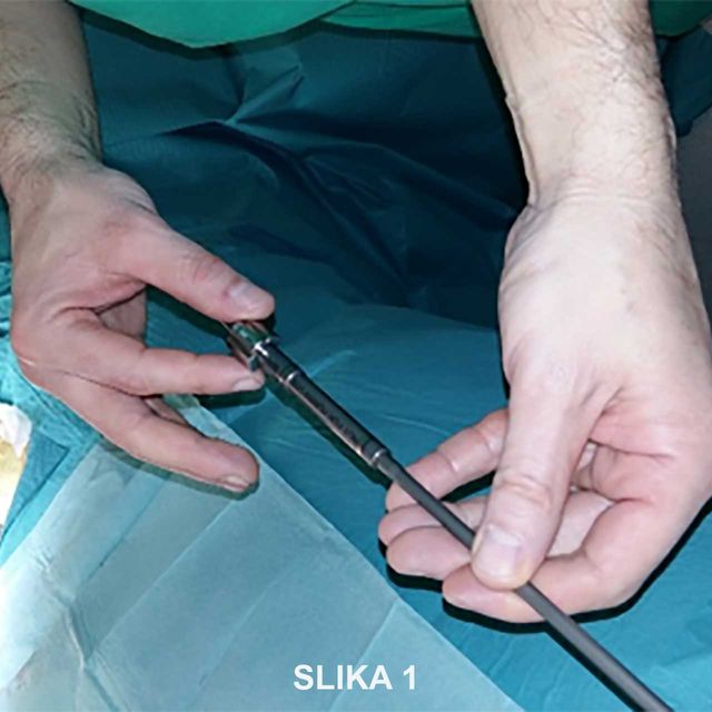 Prva operacija skolioze v Kirurškem sanatoriju MD medicina z novo metodo magnetnih palic - slika 1