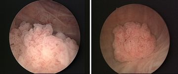 Slika 2: Cistoskopski izgled raka sečnega mehurja (VIR: fotodokumentacija MD Medicina)