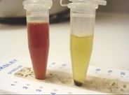 Krvavi urin (VIR: fotodokumentacija MD Medicina)